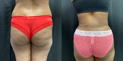 Liposuction before and after photo