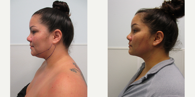 Chin Liposuction before and after photo