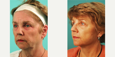 Facelift before and after photo