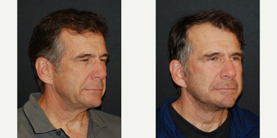 Facelift before and after photo