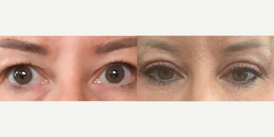 Eyelid Surgery before and after photo
