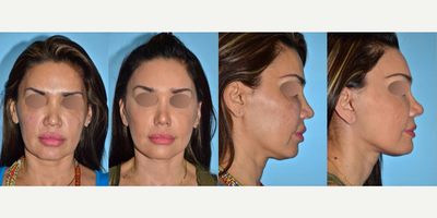 Facelift before and after photo