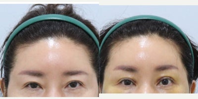 Forehead Reduction before and after photo