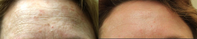 Fraxel Laser before and after photo