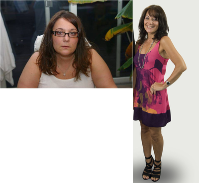 Lap Band before and after photo