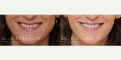Lip Lift before and after photo