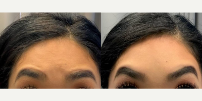 Botox before and after photo