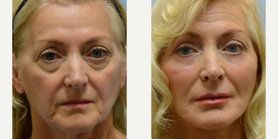 Brow Lift before and after photo
