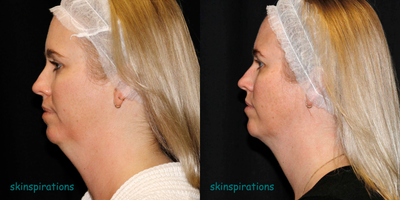 CoolSculpting before and after photo