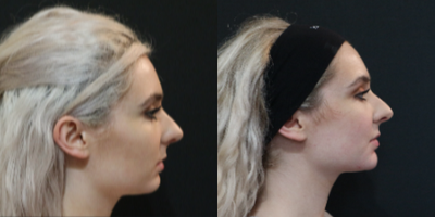 Dermal Fillers before and after photo