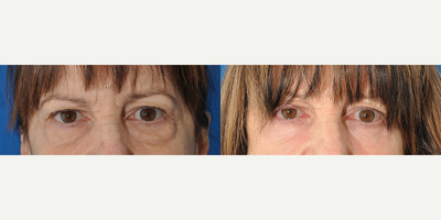 Eyelid Surgery before and after photo