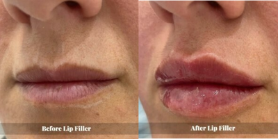 Lip Fillers before and after photo