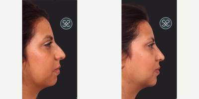 Rhinoplasty before and after photo