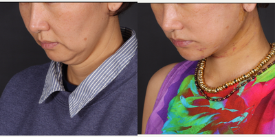 Chin Implant before and after photo