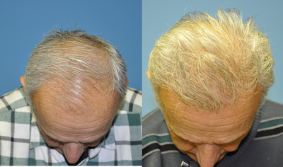 Hair Transplant before and after photo