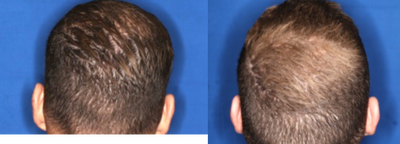 PRP for Hair Loss before and after photo