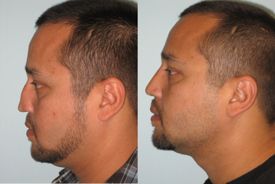 Rhinoplasty before and after photo