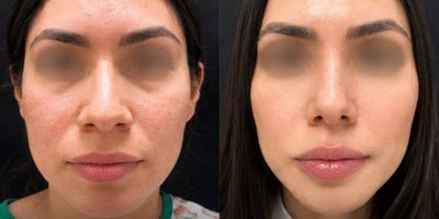 Rhinoplasty before and after photo