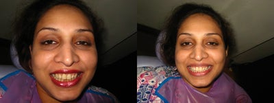 Teeth Whitening before and after photo