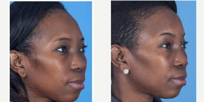 African American Rhinoplasty before and after photo