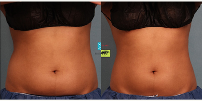 CoolSculpting before and after photo