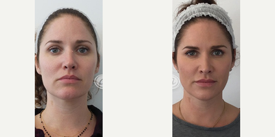 Liquid Facelift before and after photo