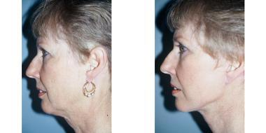 Neck Lift before and after photo
