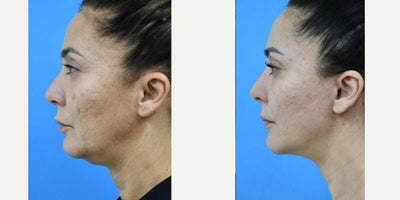 Neck Lift before and after photo