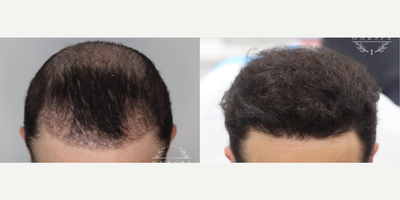 PRP for Hair Loss before and after photo