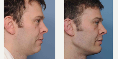 Chin Implant before and after photo