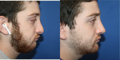 Chin Implant before and after photo