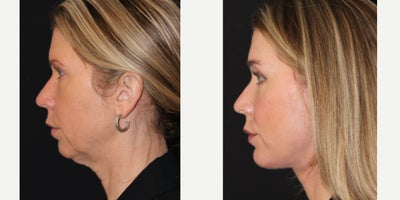 Chin Implant before and after photo