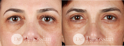 Eyelid Surgery before and after photo