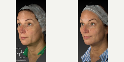 Botox before and after photo