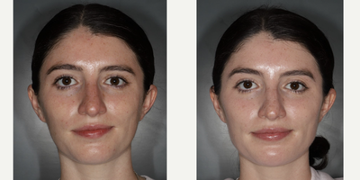 Cheek Fillers before and after photo