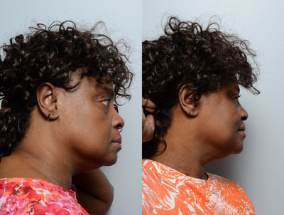 Earlobe Repair before and after photo