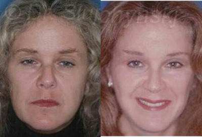 Eyelid Surgery before and after photo