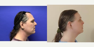 Forehead Reduction before and after photo