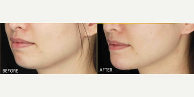 Juvederm before and after photo