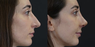 Rhinoplasty before and after photo