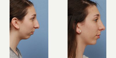 Rhinoplasty before and after photo