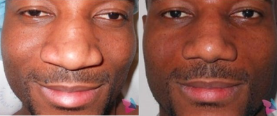African American Rhinoplasty before and after photo