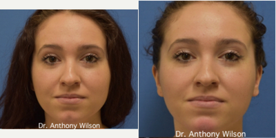 Chin Implant before and after photo