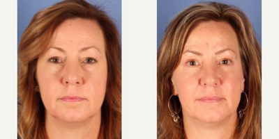 Eyelid Surgery before and after photo