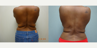 Liposuction before and after photo