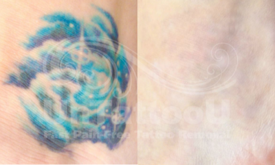 Tattoo Removal before and after photo