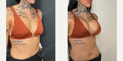 Breast Augmentation before and after photo