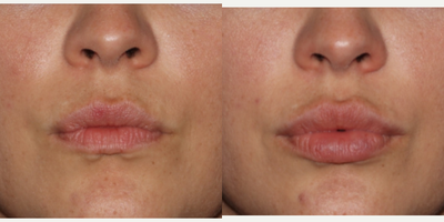 Lip Fillers before and after photo