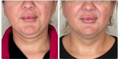 Agnes RF before and after photo
