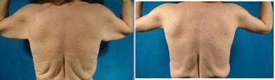 Body Lift before and after photo